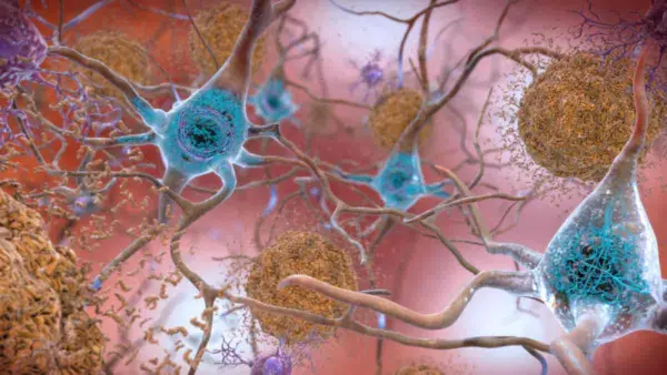 standard_compressed_Alzheimers_tau_og_beta-amyloid