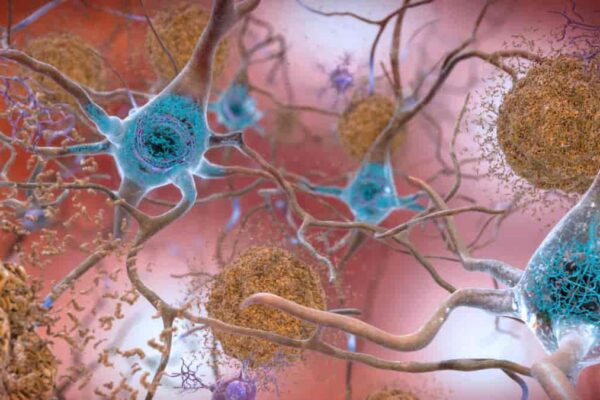 standard_compressed_Alzheimers_tau_og_beta-amyloid
